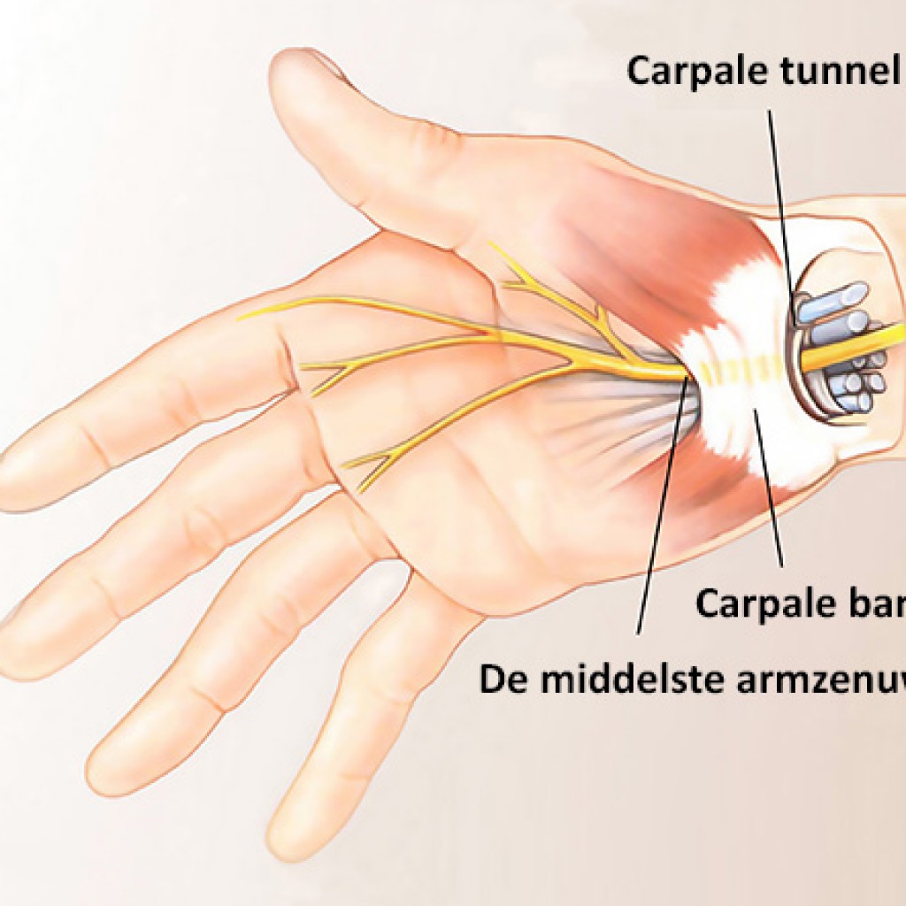 neurospine: Carpaal tunnelsyndroom (CTS)